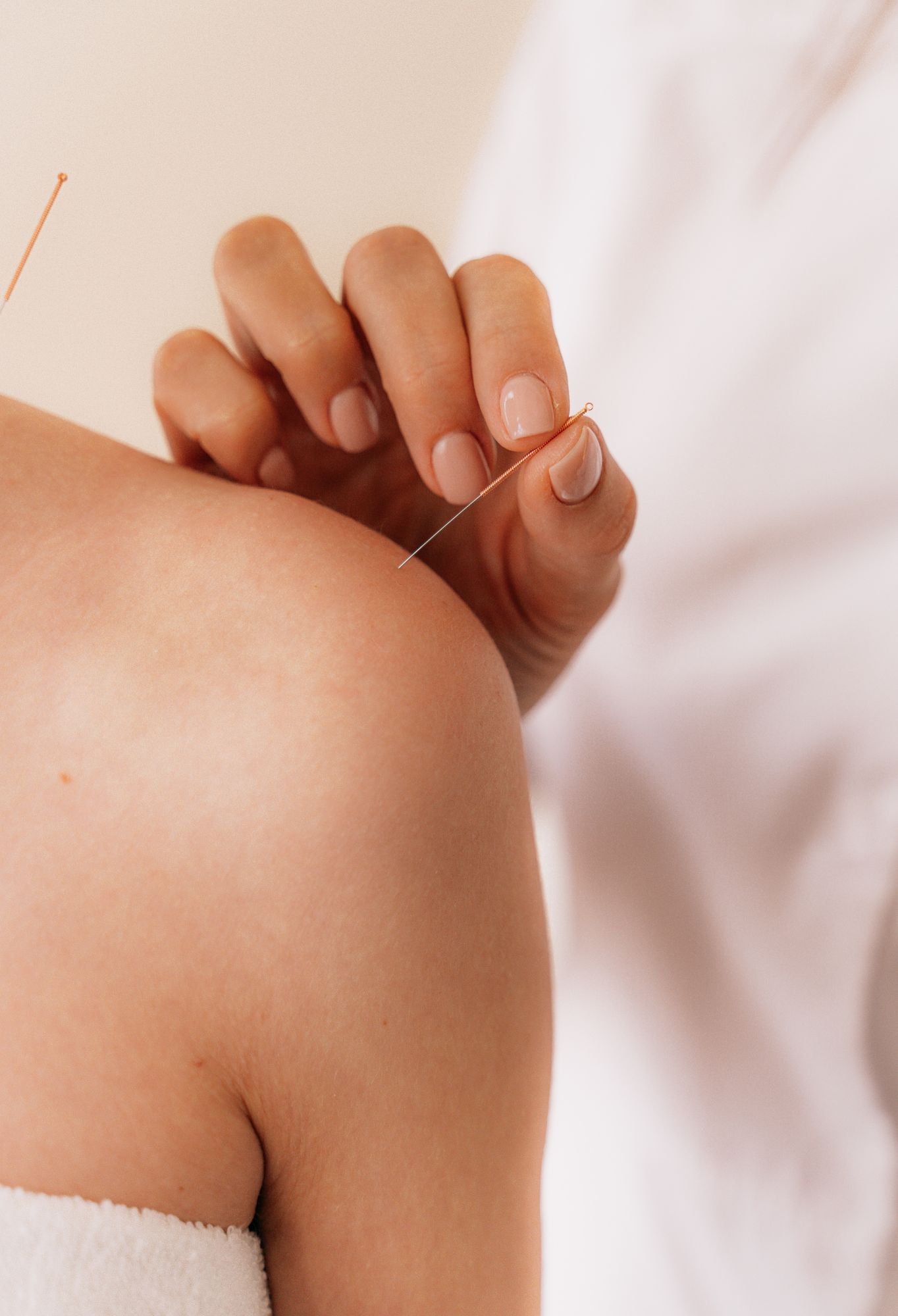 Acupuncture