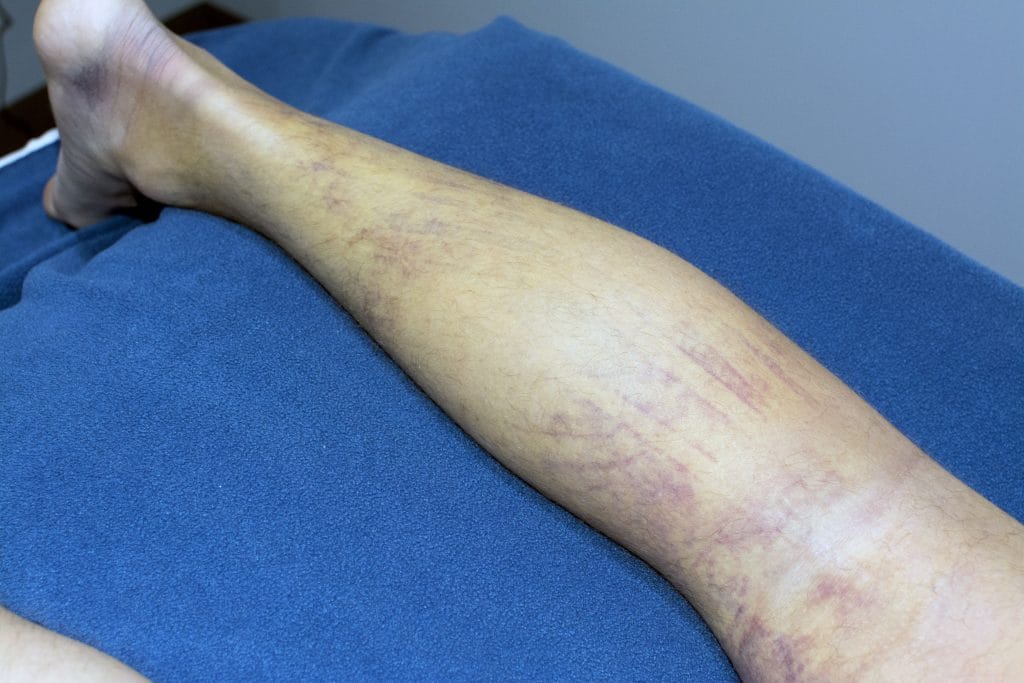 30 hours post ktape