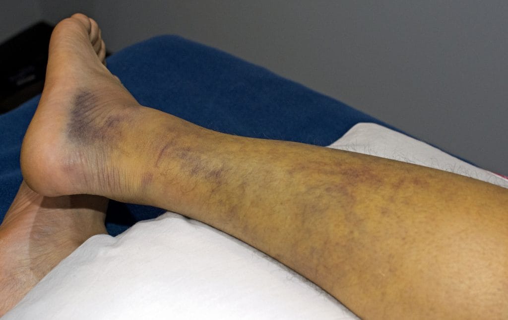 leg-initial