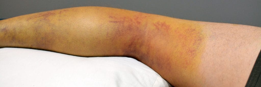 leg-tape-initial